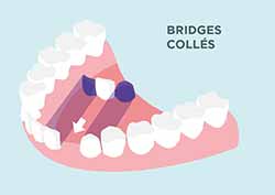 HAS Bridges- colles