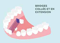 HAS Bridges- colles en extension