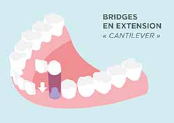 HAS Bridges- en extension