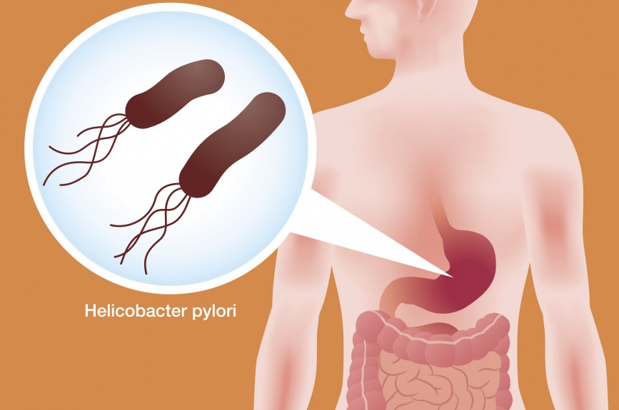 illustration estomac Helicobacter pylori