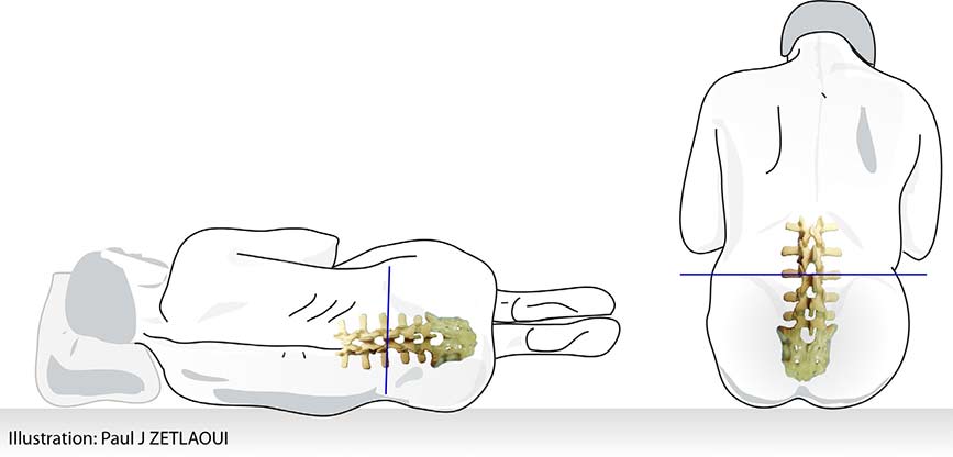 ponction lombaire illustration du patient