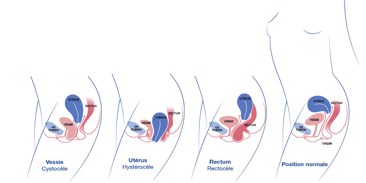 Prolapsus Positions