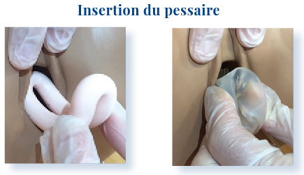 PROLAPSUS-Fiche le pessaire insertion,p2