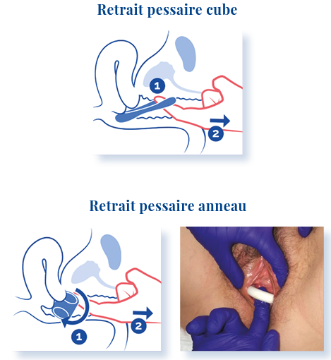 PROLAPSUS-Fiche le pessaire le retirer,p3